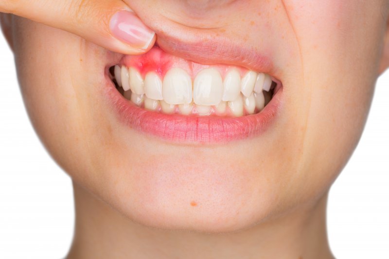 woman shows pink spot on gums