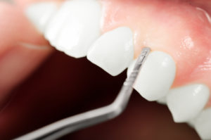 Close-up of exam for gum disease in Gahanna